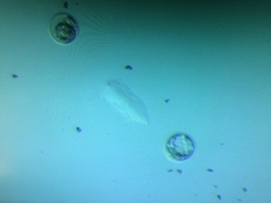 Återföring av två blastocyster, en fryst och en färsk.
